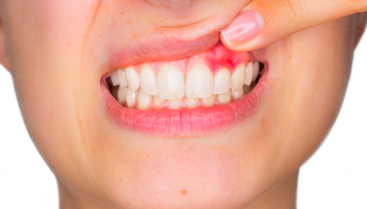 Top-14-tratamente-naturale-pentru-gingii-inflamate.jpg