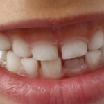 De-ce-sangereaza-gingiile-si-cum-se-trateaza.jpg