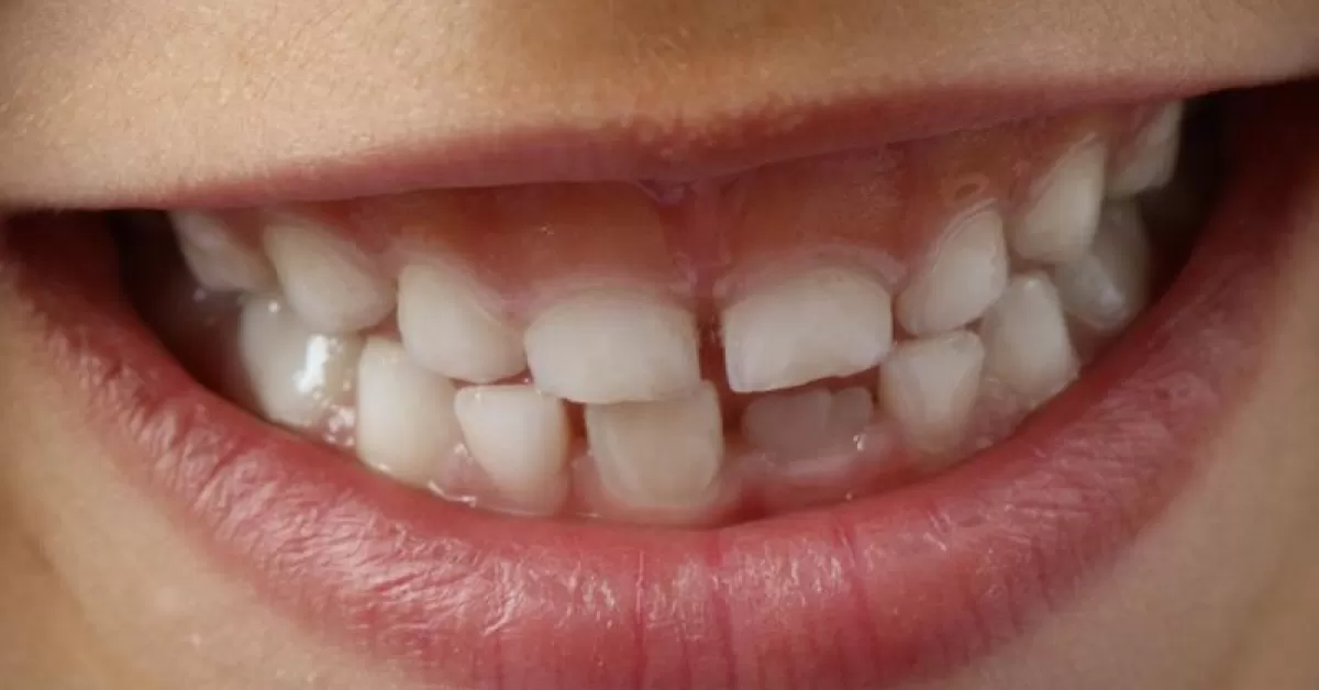 De-ce-sangereaza-gingiile-si-cum-se-trateaza.jpg